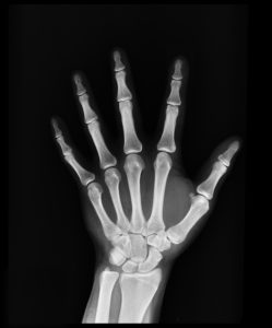 Tips for dealing with your kid's broken bones - PreparaMom